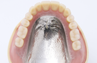 1） 金属の入れ歯