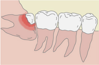 3） 智歯周囲炎になりやすい